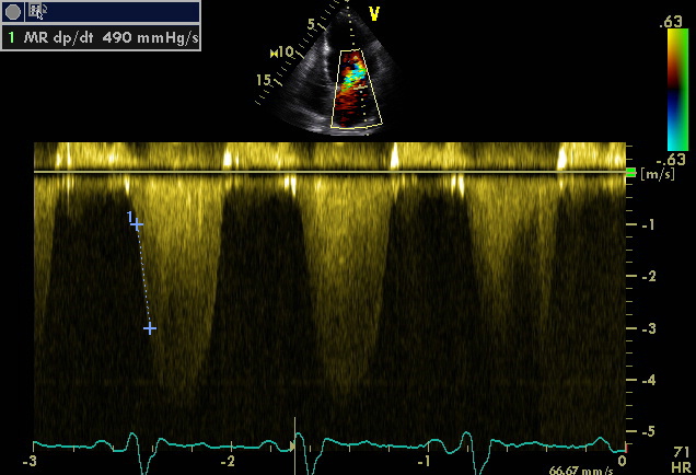 MR dP/dT decreased LV function