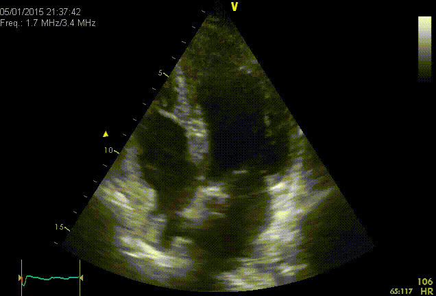 Akinesia of the apex and hypercontractile base of LV