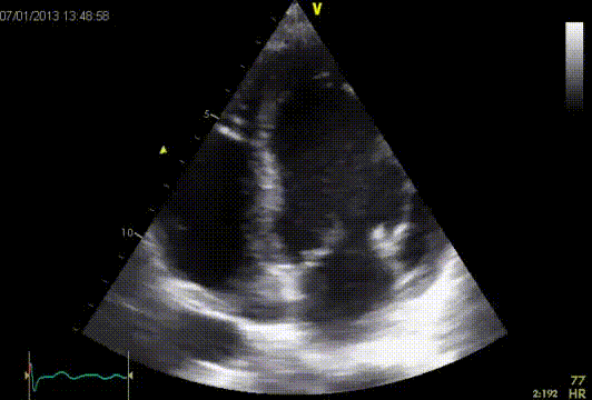 Vegetation mitral valve