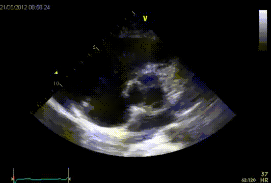 Bicuspid type 2