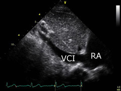 IVC subcostal view