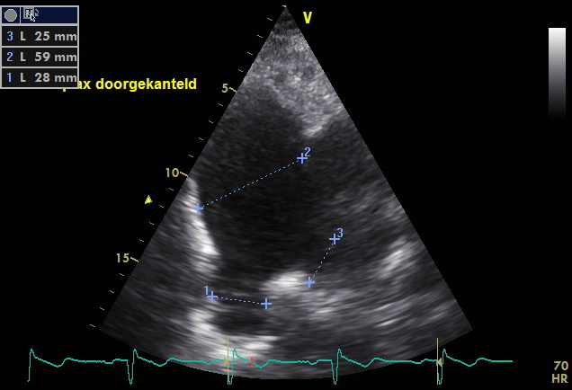 Dilation of pulmonary arteries