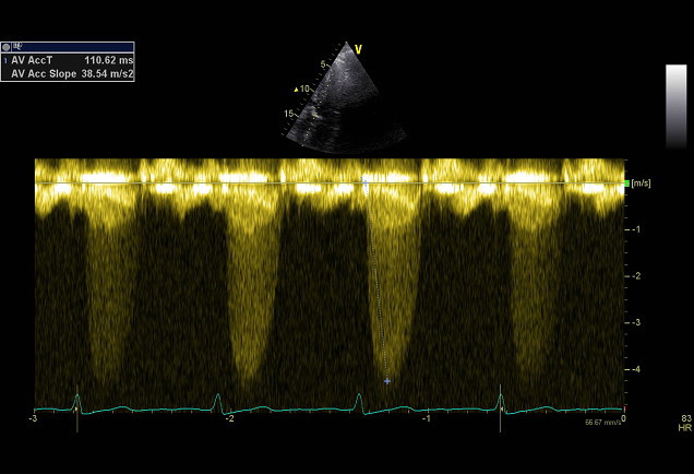 AV severe stenosis