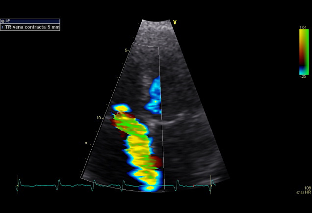 TR vena contracta