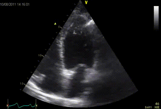 Apical trabecularisation
