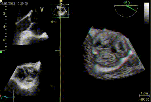 3D-image of a tricuspid aortic valve (TEE)
