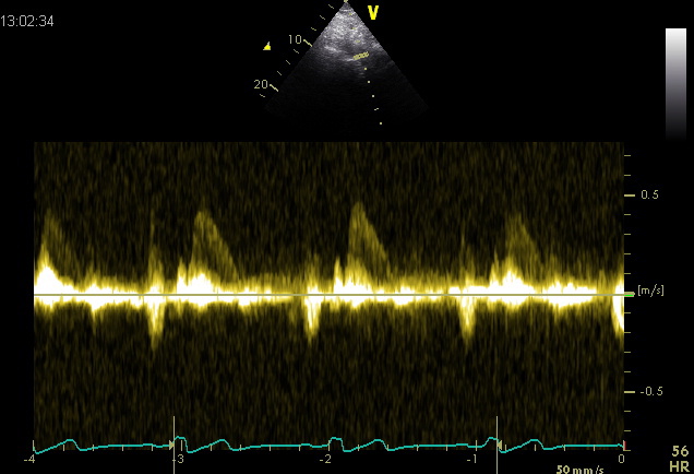Descending aorta normal flow