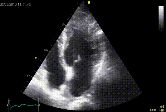 Apical hypertrophy