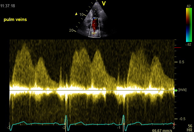 Pulmvein 1