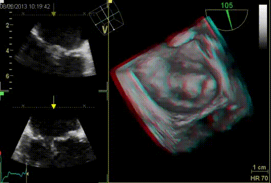 Ruptured mitral chordae tendineae assessed with 3D TEE