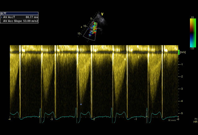 AV mild stenosis