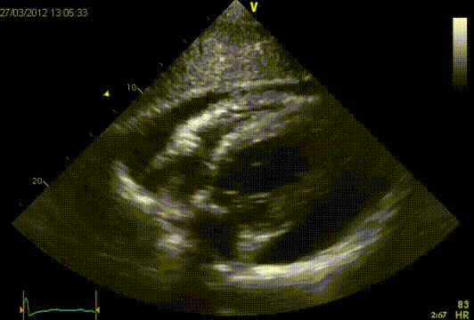 Tamponade