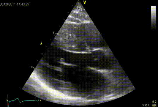 Asymmetric hypertrophy