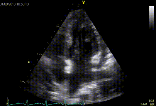 ASD II demonstrated with saline agitation