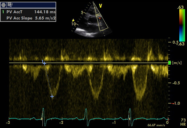 PV normal acceleration time