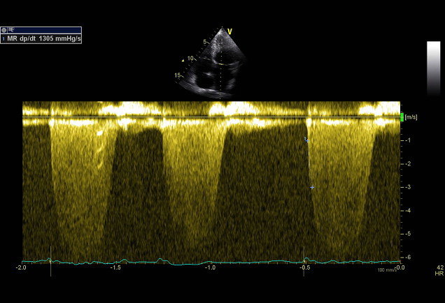 MR dP/dT normal LV function