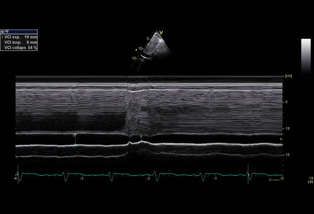 IVC collaps registered with m-mode
