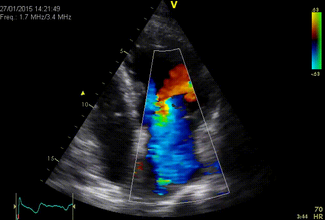 Severe MR because of prolaps