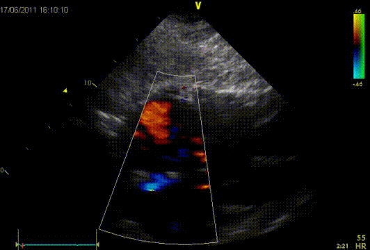 Large ASD II subcostal view