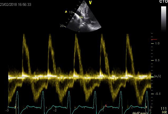 Descending aorta flow reversal (severe AR)