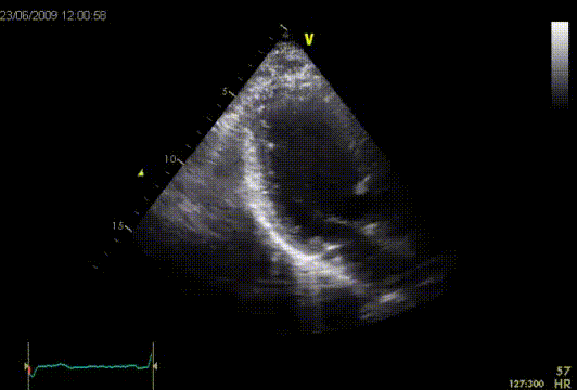 Fibroelastoom