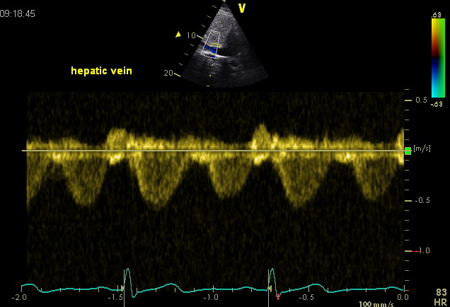 Hepatic vein flow